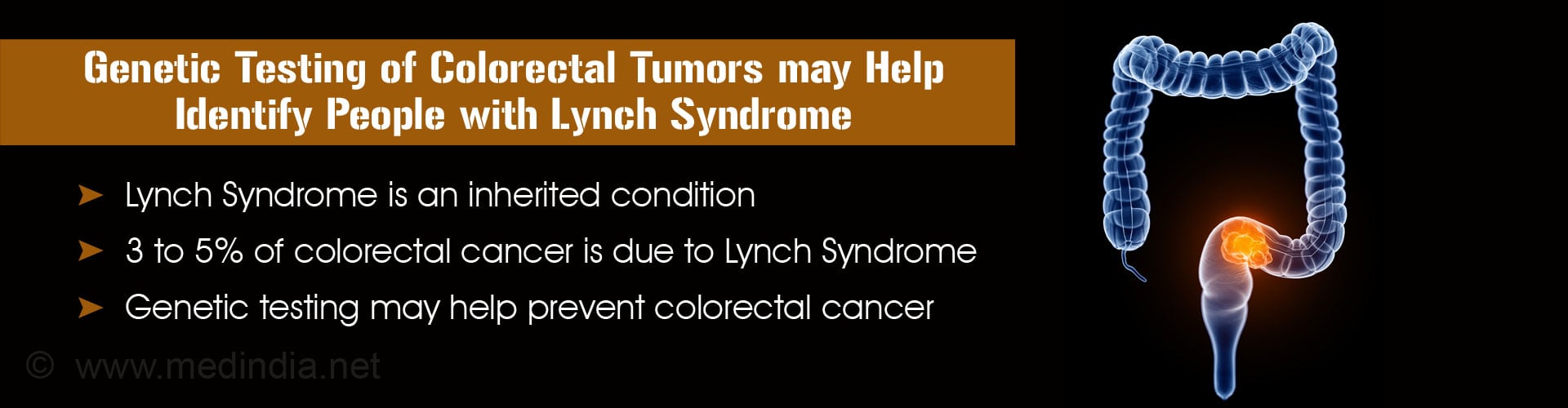 New Treatment Method Reduces Adverse Effects of Rectal Cancer Surgery New Treatment Method Reduces Adverse Effects of Rectal Cancer Surgery