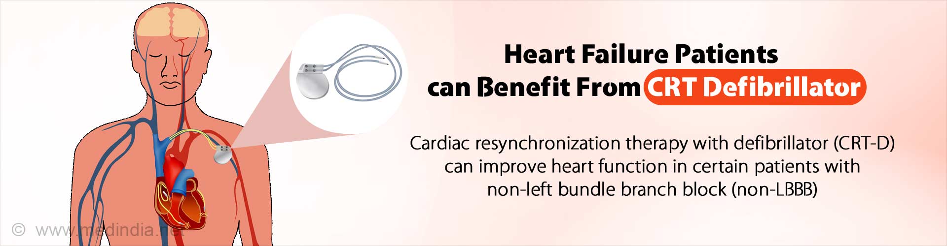 CRT Defibrillator May Improve Heart Function In Certain Patients CRT Defibrillator May Improve Heart Function In Certain Patients