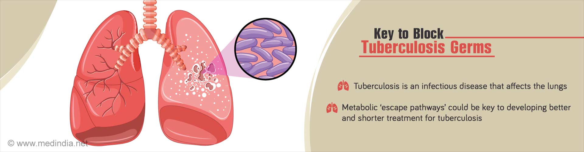 Key to Better, Shorter Tuberculosis Treatment Identified