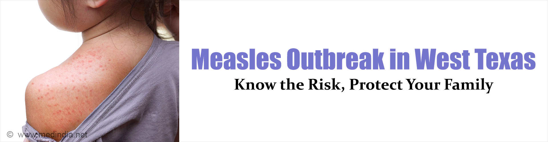 Measles Outbreak in Texas: 597 Cases, 62 Hospitalizations, 2 Deaths