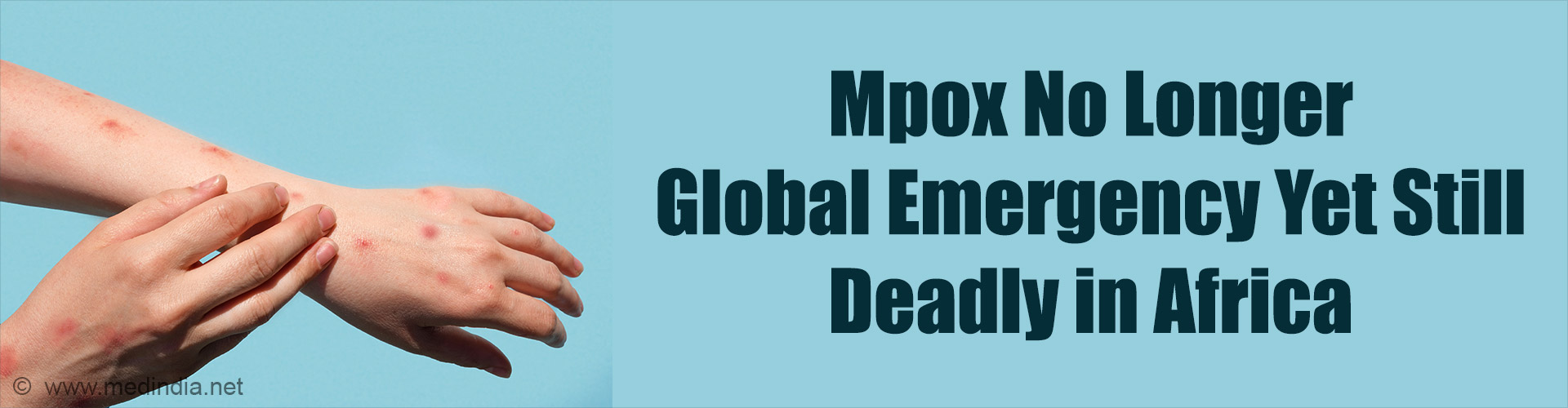 WHO Declares End to Mpox Emergency But Warns of African Surge