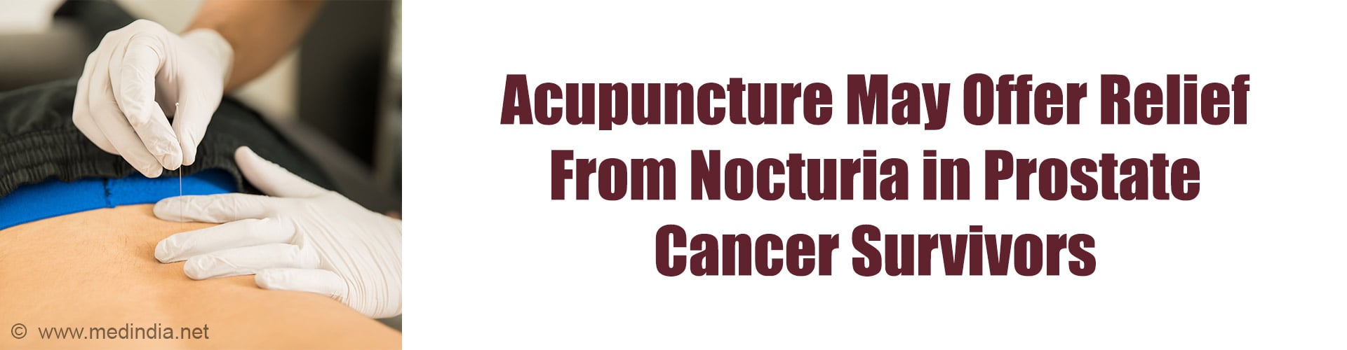 Acupuncture May Ease Nocturia in Prostate Cancer Survivors Acupuncture May Ease Nocturia in Prostate Cancer Survivors