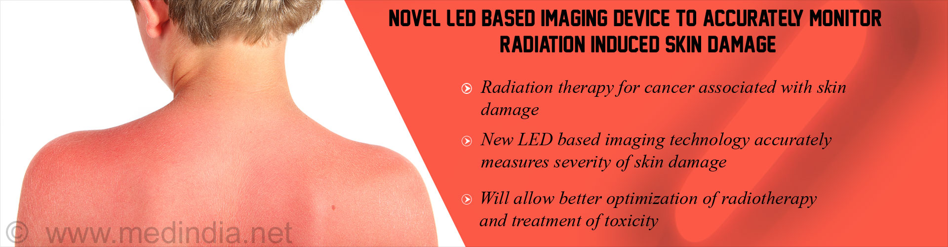 LED Device Measures Radiation Induced Skin Toxicity
