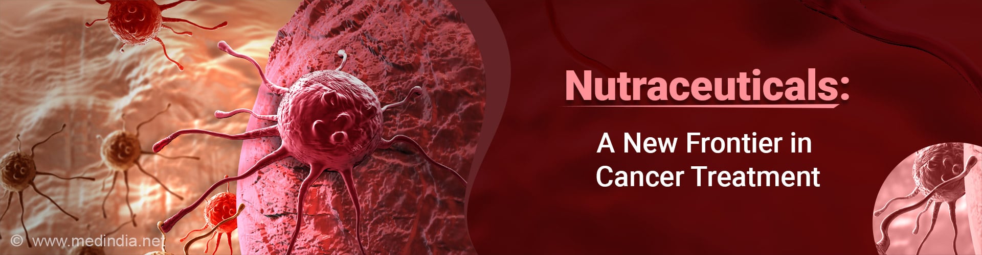 Nutraceutical Therapy Aims to Halt Cancer Spread