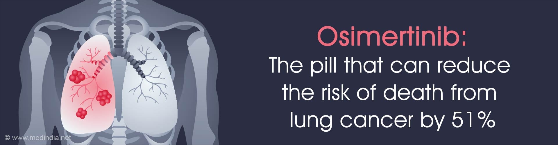 Have We Found a Cure for Lung Cancer? Have We Found a Cure for Lung Cancer?