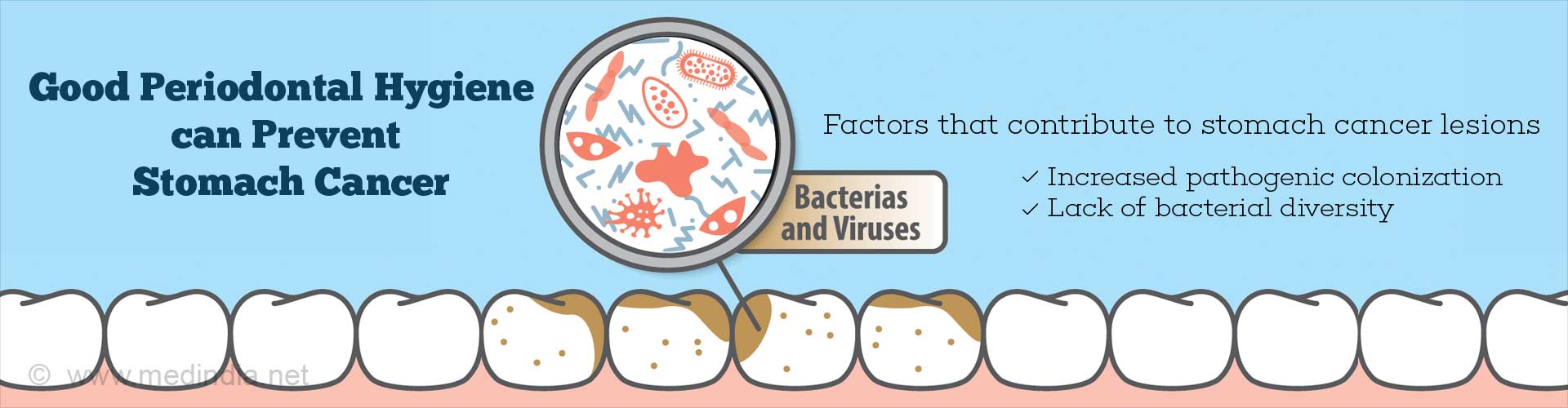 Periodontal Disease Control may Prevent Stomach Cancer