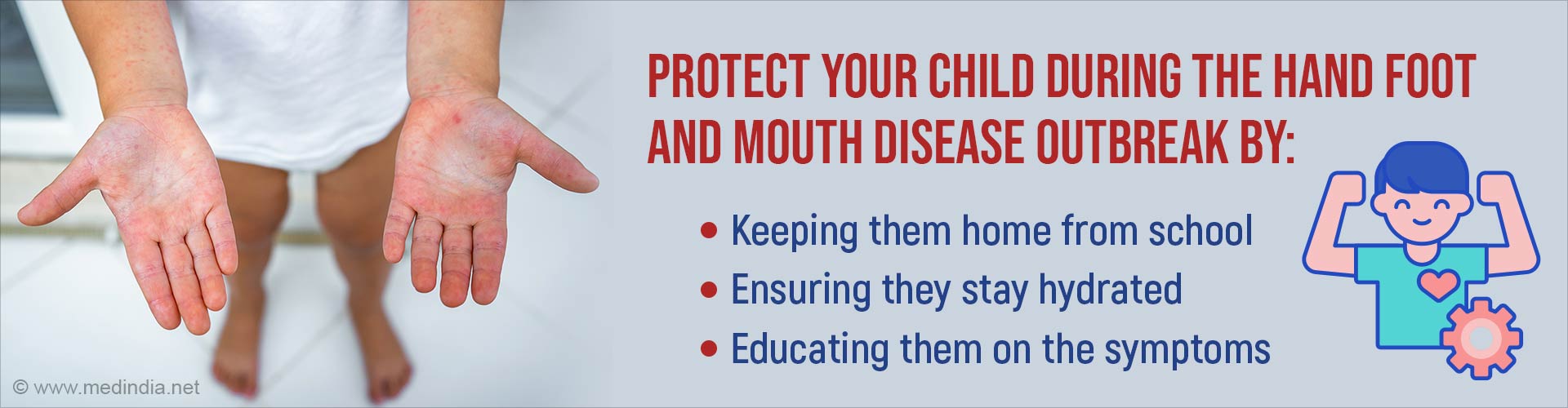 Hand, Foot, and Mouth Disease Cases Surge in Kolkata