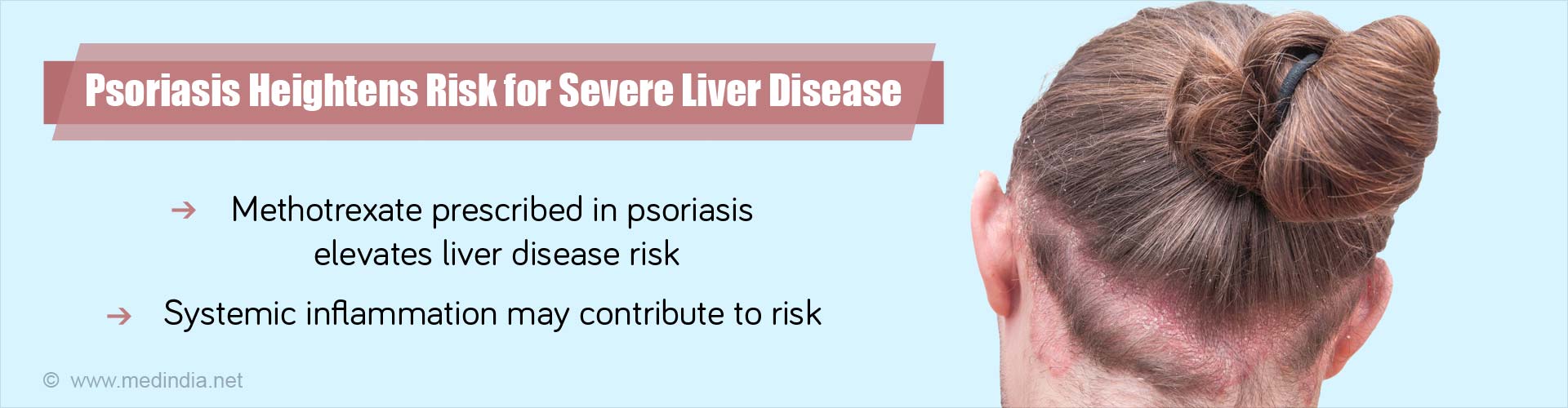 Psoriasis (PsO) Heightens Risk for Serious Liver Disease