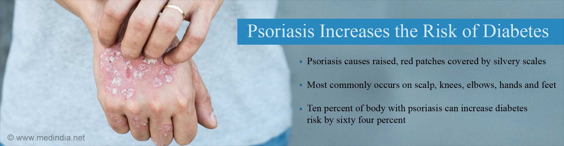 Psoriasis Can Increase The Risk of Type 2 Diabetes