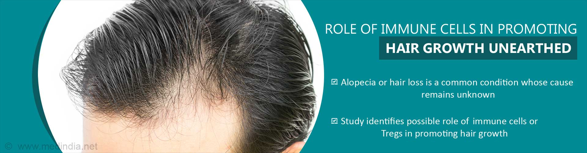 Hair Loss- Defective Skin Immune Cell Link Unearthed