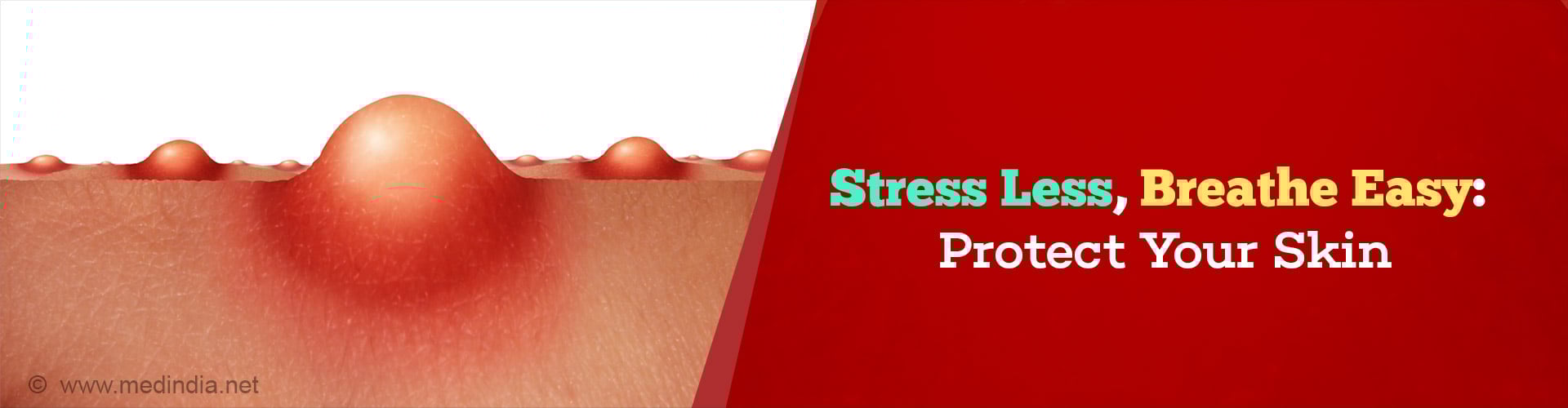 Stress and Skin Allergies: Causes, Effects, and Innovative Treatments