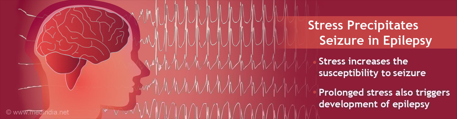 Stress Triggers Seizure in Epilepsy Patients Stress Triggers Seizure in Epilepsy Patients