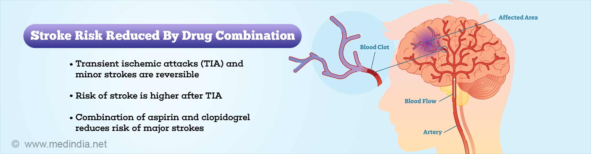Stroke Prevented by Acute Intervention of Antiplatelet Drug Combination