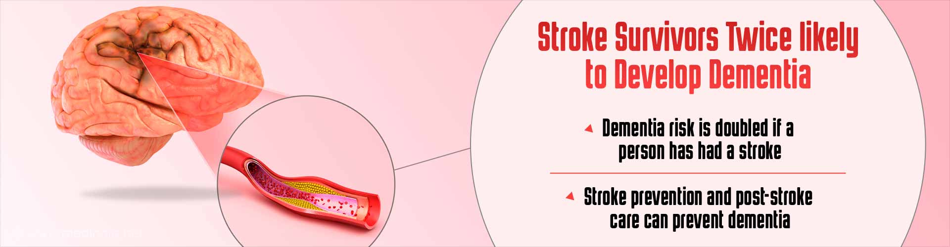 Stroke Doubles Risk of Dementia