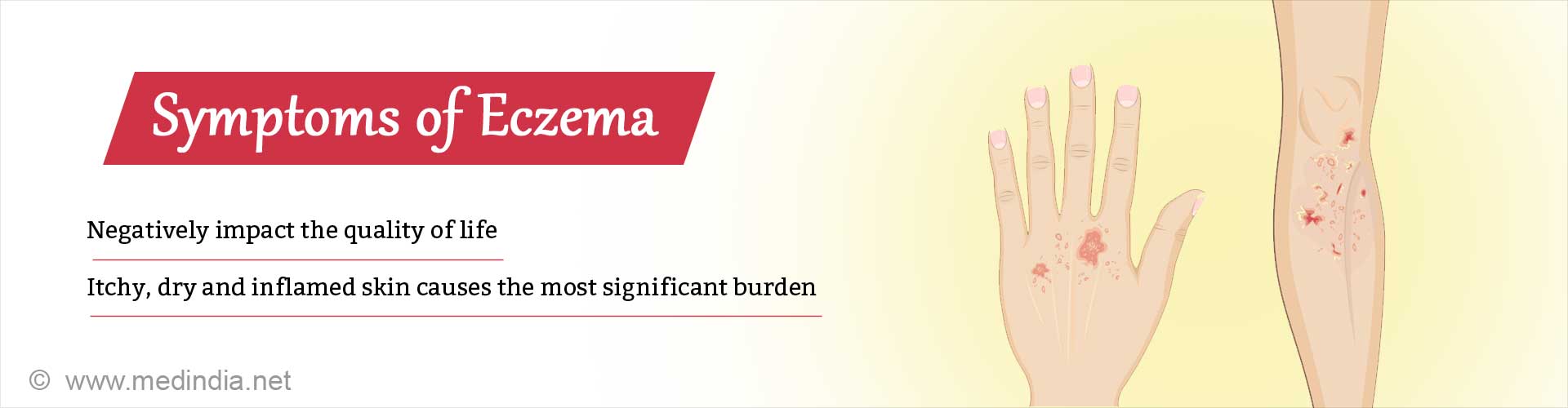 Eczema Impacts Quality of Life More Than Chronic Illnesses Like Heart Disease