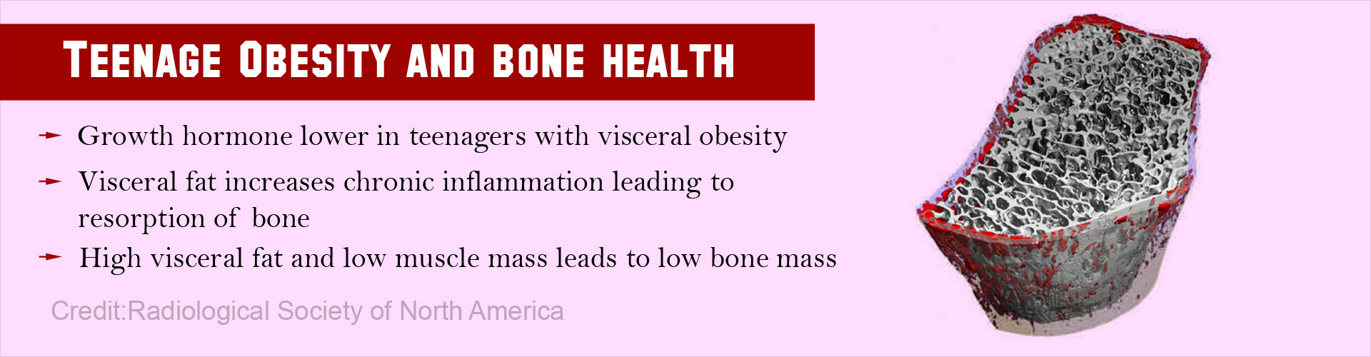Teenage Obesity Permanently Affects Bone Health