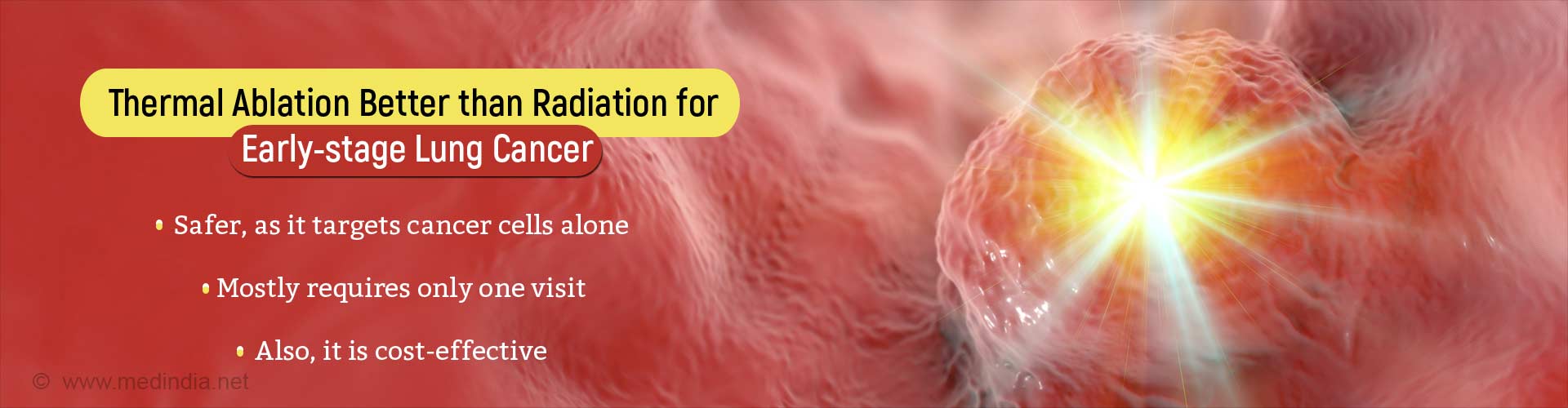 Thermal Ablation as a First Step in Treating Early-stage Lung Cancer