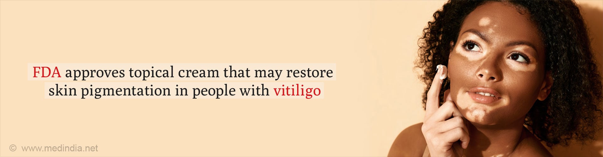 Topical Cream for Vitiligo Brings Back Normal Skin Colour