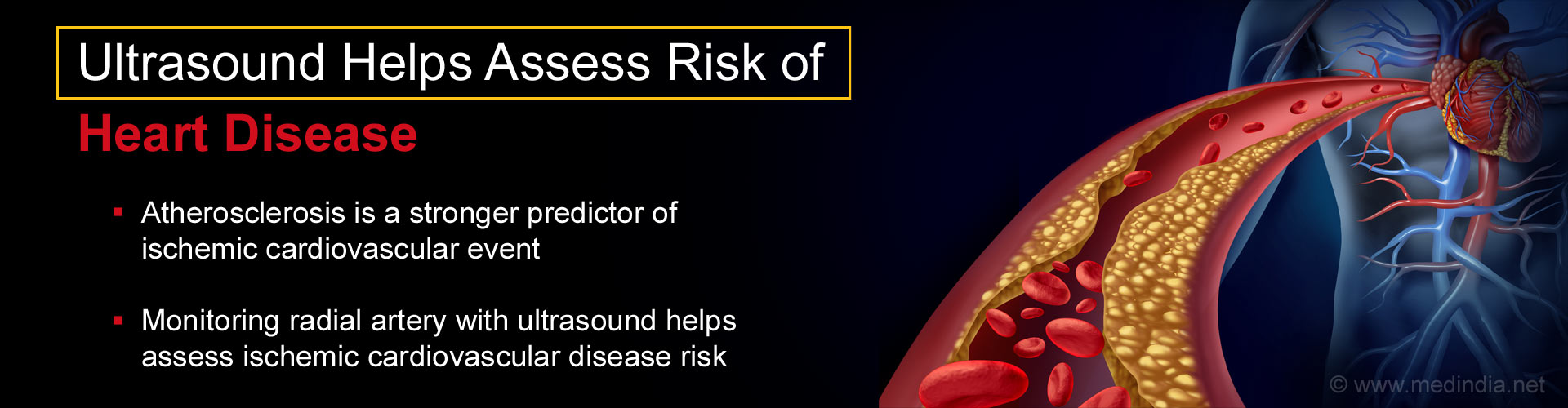 New Indicator of Heart Disease Identified