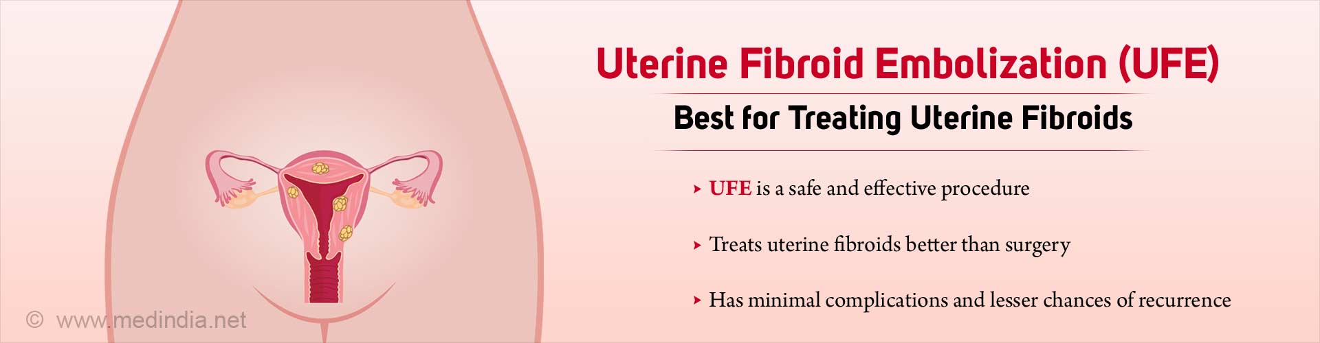 Uterine Fibroid Embolization Treatment Better Than Surgery Uterine Fibroid Embolization Treatment Better Than Surgery