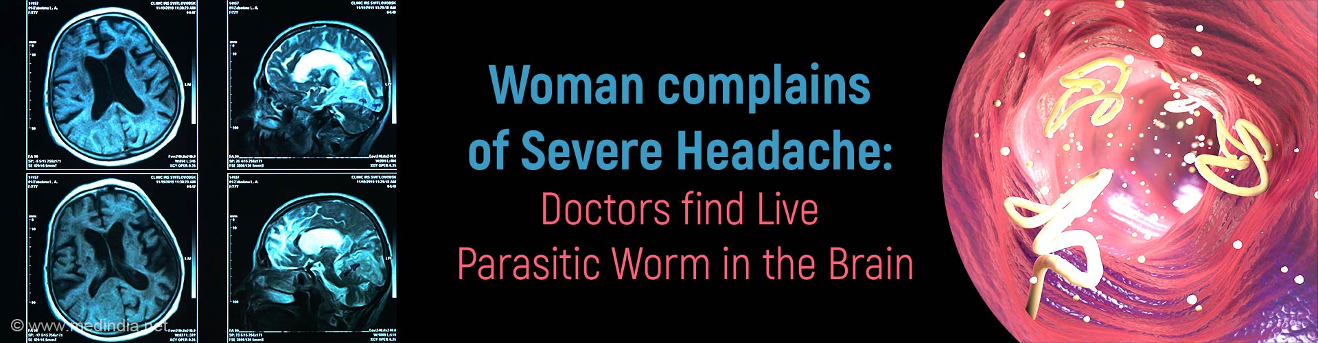 World First Discovery Live Parasitic Worm Found In Australian Womans Brain 7847