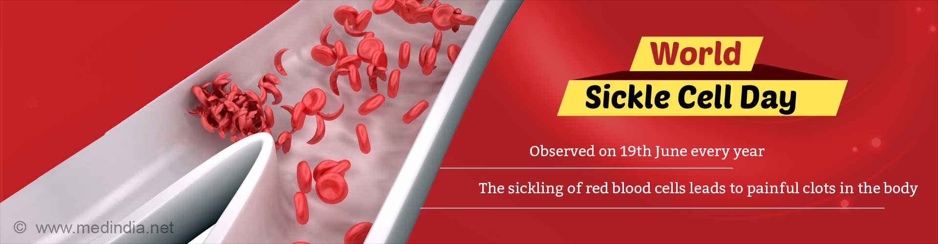 World Sickle Cell Anemia Day