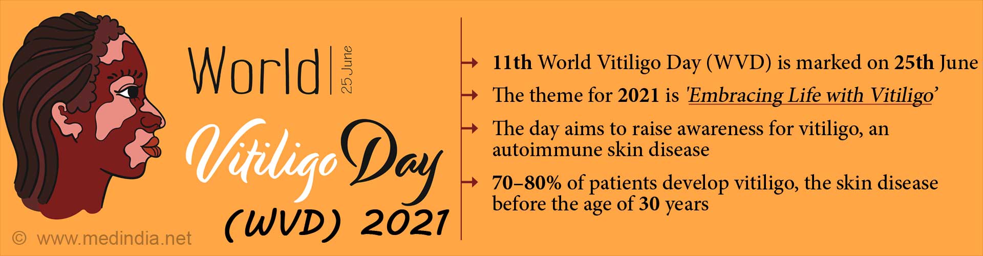 World Vitiligo Day 2021: Embracing Life With Vitiligo