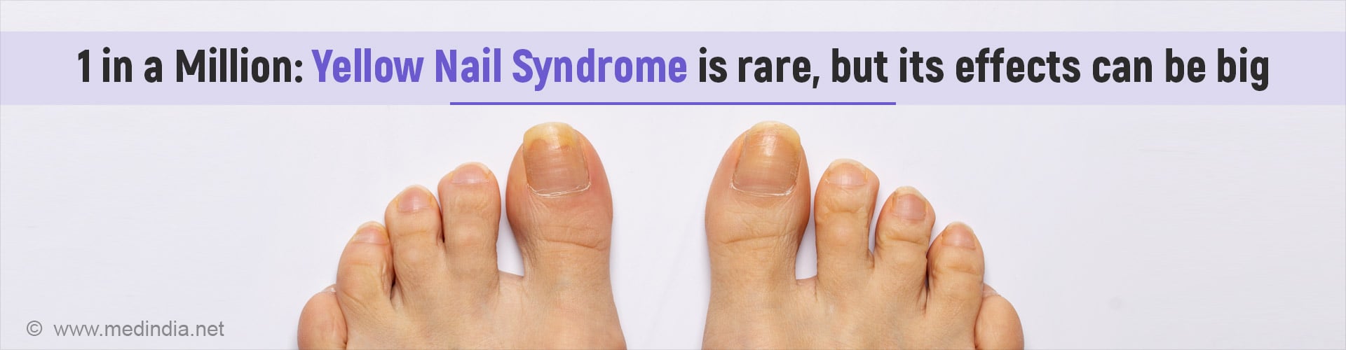 Yellow Nail Syndrome: A Rare Condition Affecting Nails, Lungs, and Lymphatic System