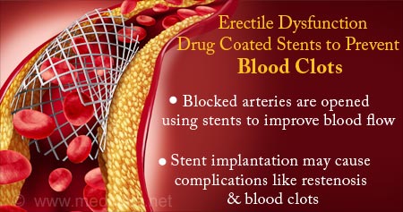 Viagra Coated Stent Reduces Blood Clots Prevents Narrowing of