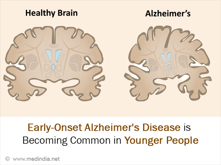 World's Youngest Case of Alzheimer’s Disease