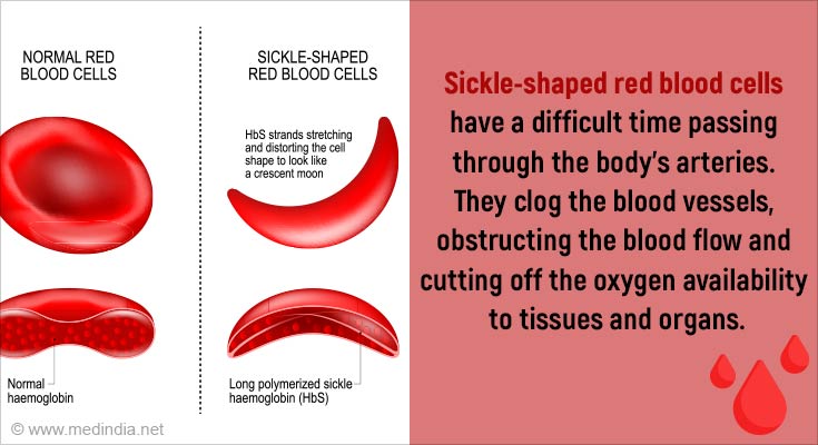 Sickle Cell Anemia's Death Toll 11 Times Higher Than Estimated