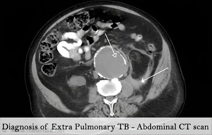 Abdomen CT Abdomen CT