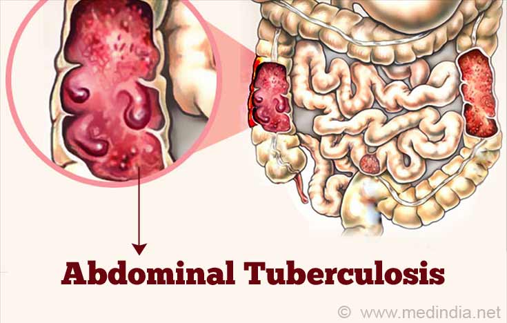 Stomach / Intestinal / Abdominal Tuberculosis Stomach / Intestinal / Abdominal Tuberculosis