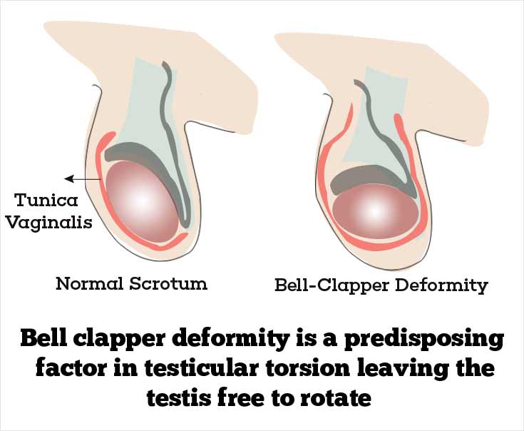 Risk Factors of Testicular Torsion - Bell-Clapper Deformity Risk Factors of Testicular Torsion - Bell-Clapper Deformity