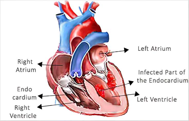 Boils: Endocarditis Boils: Endocarditis