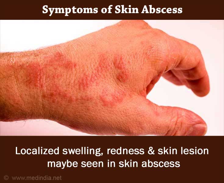 Boils: Skin redness Boils: Skin redness