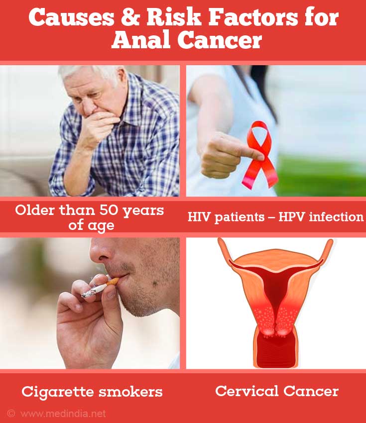 Causes & Risk Factors for Anal Cancer Causes & Risk Factors for Anal Cancer
