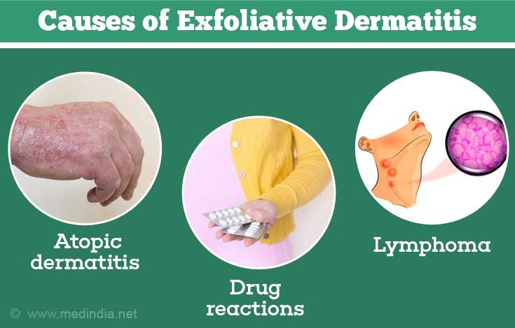 Causes of Exfoliative Dermatitis Causes of Exfoliative Dermatitis