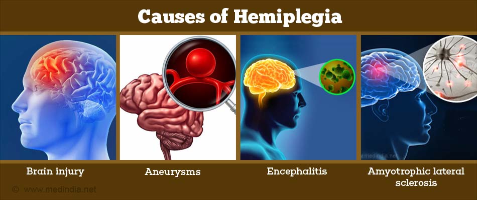 Causes of Hemiplegia Causes of Hemiplegia