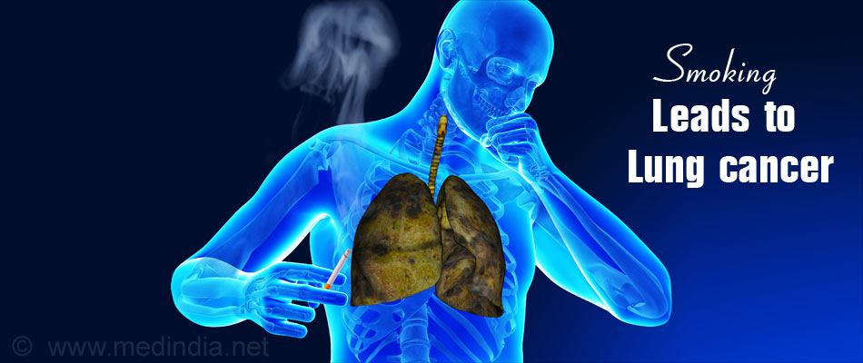 Causes of Lung Cancer - Smoking Causes of Lung Cancer - Smoking