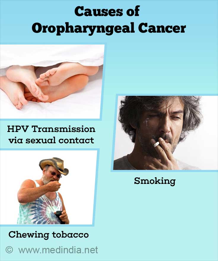 Causes of Oropharyngeal Cancer Causes of Oropharyngeal Cancer