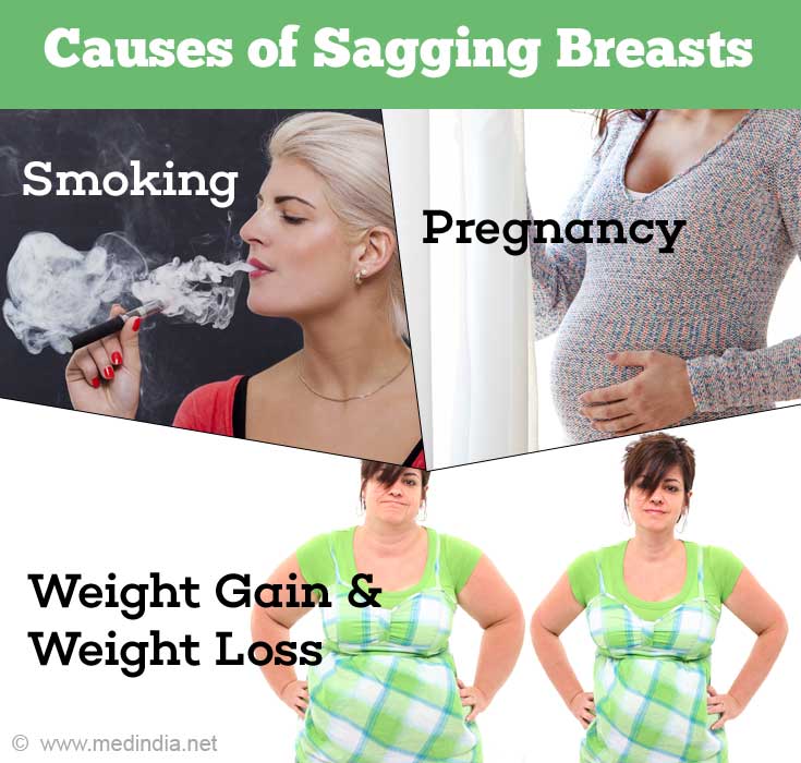 Causes of Sagging Breasts Causes of Sagging Breasts