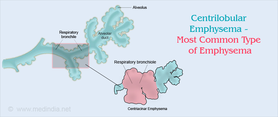 Centrilobular Emphysema - Most Common Type of Emphysema Centrilobular Emphysema - Most Common Type of Emphysema