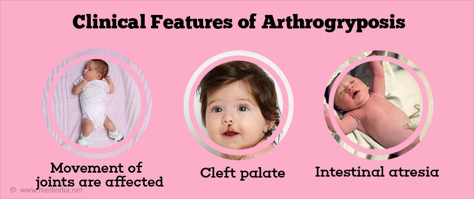 Clinical features of Arthrogryposis Clinical features of Arthrogryposis