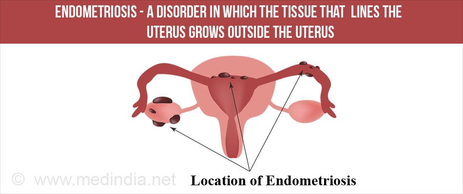 Endometriosis Endometriosis