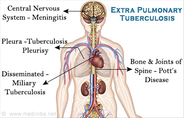 Extra Pulmonary Tuberculosis Extra Pulmonary Tuberculosis