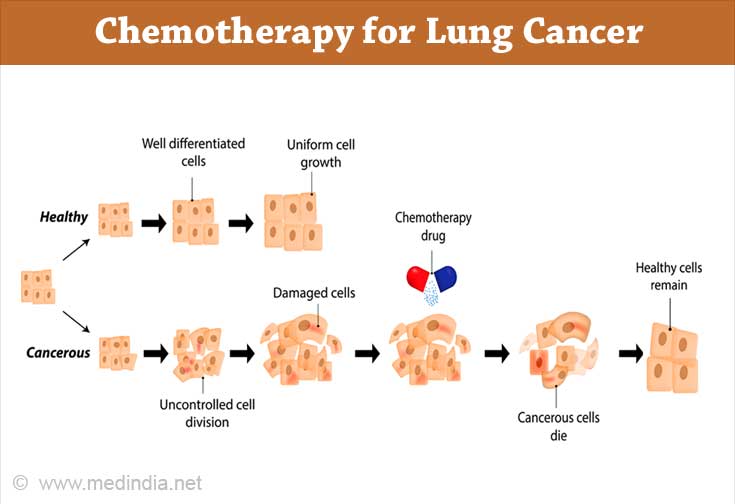 Lung Cancer Treatment - Chemotherapy Lung Cancer Treatment - Chemotherapy
