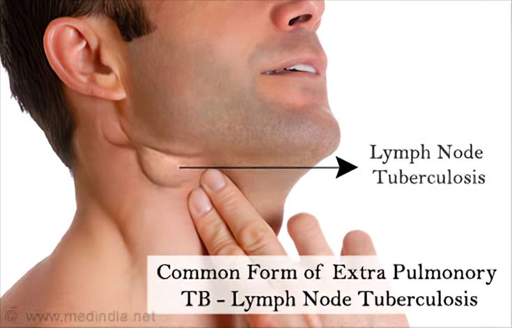 Lymph Node Tuberculosis Lymph Node Tuberculosis