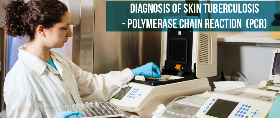 Diagnosis of Skin Tuberculosis - PCR Diagnosis of Skin Tuberculosis - PCR