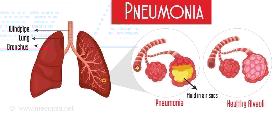 Pneumonia Pneumonia